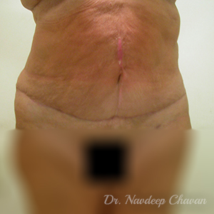 post-op-abdominoplasty