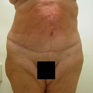 post-op-abdominoplasty