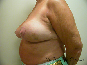 post-op-breast-reduction