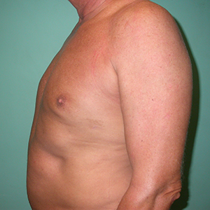 post-op-gynecomastia