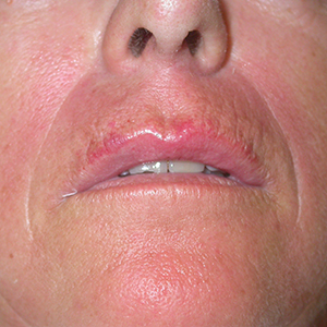 post-op-lip-augmentation