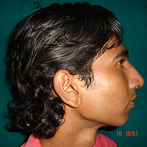 post-op-rhinoplasty