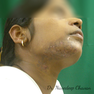 post-op-vitiligo