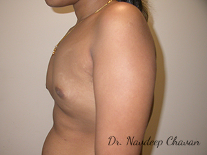 pre-op-breast-augmentation