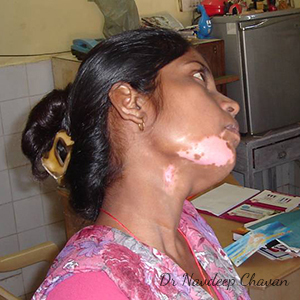 pre-op-vitiligo