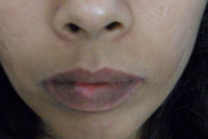 Vitiligo Lip 