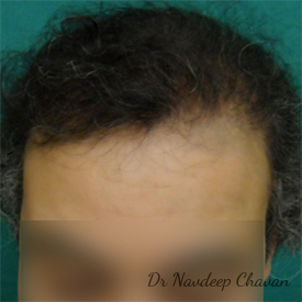 post op hair transplant