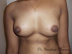 post-op-breast-augmentation