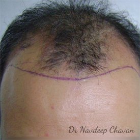 pre op hair transplant