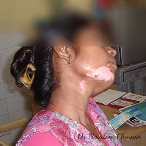 pre-op-vitiligo