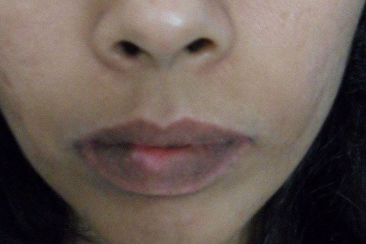 Vitiligo Lip