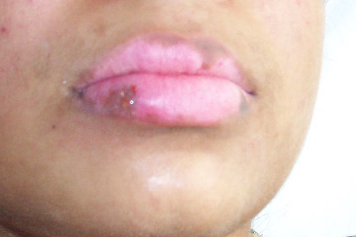 vitiligo-lip