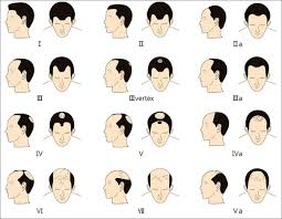 baldness classification in male (mpb)