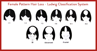 female baldness classification